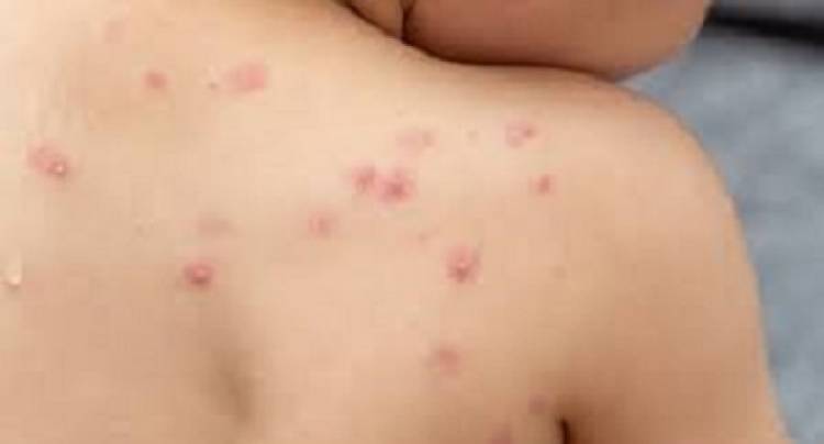 NACIÓN EMITIÓ UNA ALERTA EPIDEMIOLÓGICA SOBRE LA VIRUELA SÍMICA