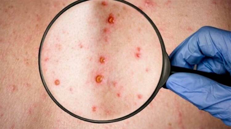 LA OMS DECLARA LA ALERTA MÁXIMA POR SUBA DE CASOS DE VIRUELA DEL MONO EN EL MUNDO